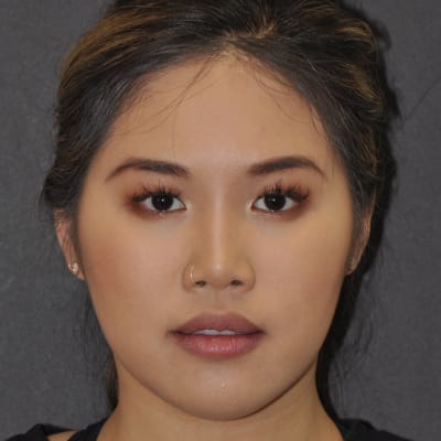 After: Botox for Jaw Pain